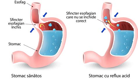 Varicele icb ale esofagului